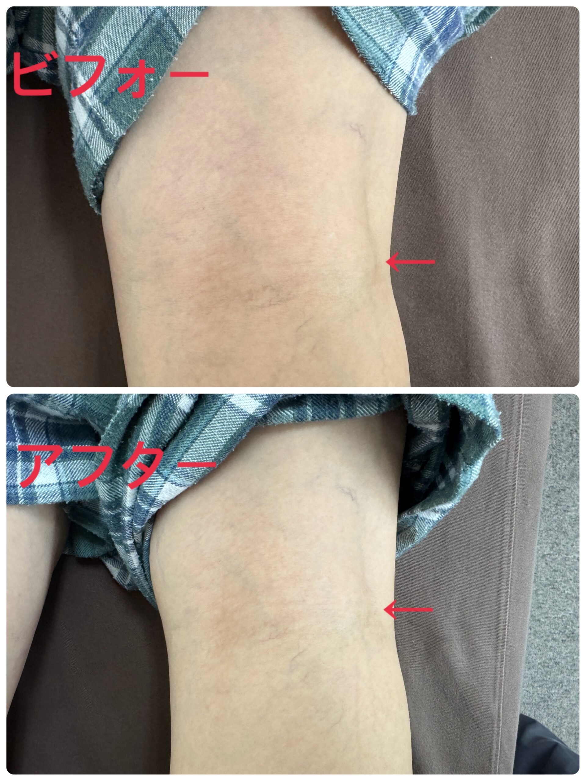 【初回の施術時の写真】膝うら外側の腫れがスッキリしました